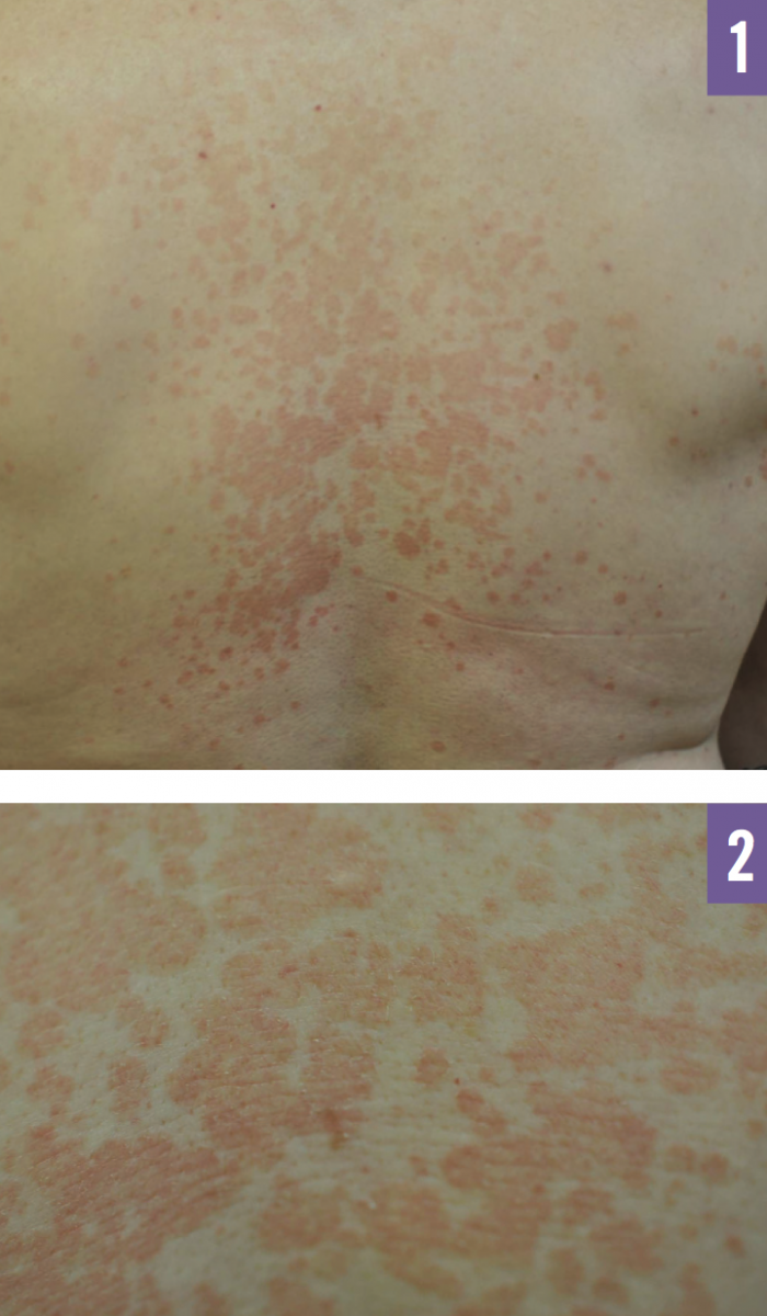 Tinea Versicolor Consultant360